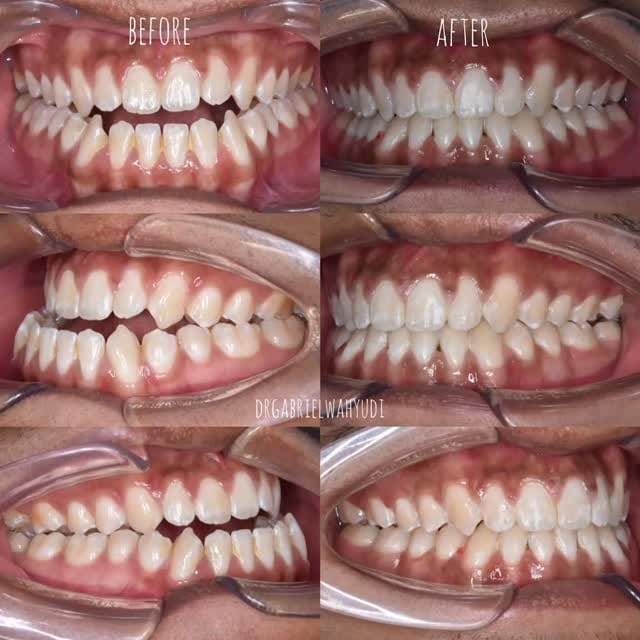 Post 1 by dr Ji Gong | DOKTER GIGI SBY on Instagram (video)
