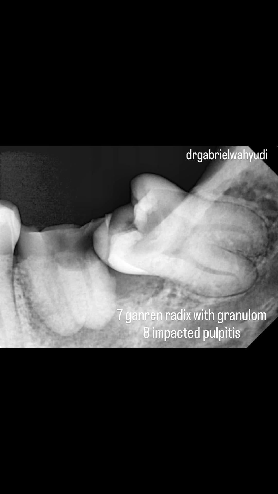 Post 5 by dr Ji Gong | DOKTER GIGI SBY on Instagram (video)