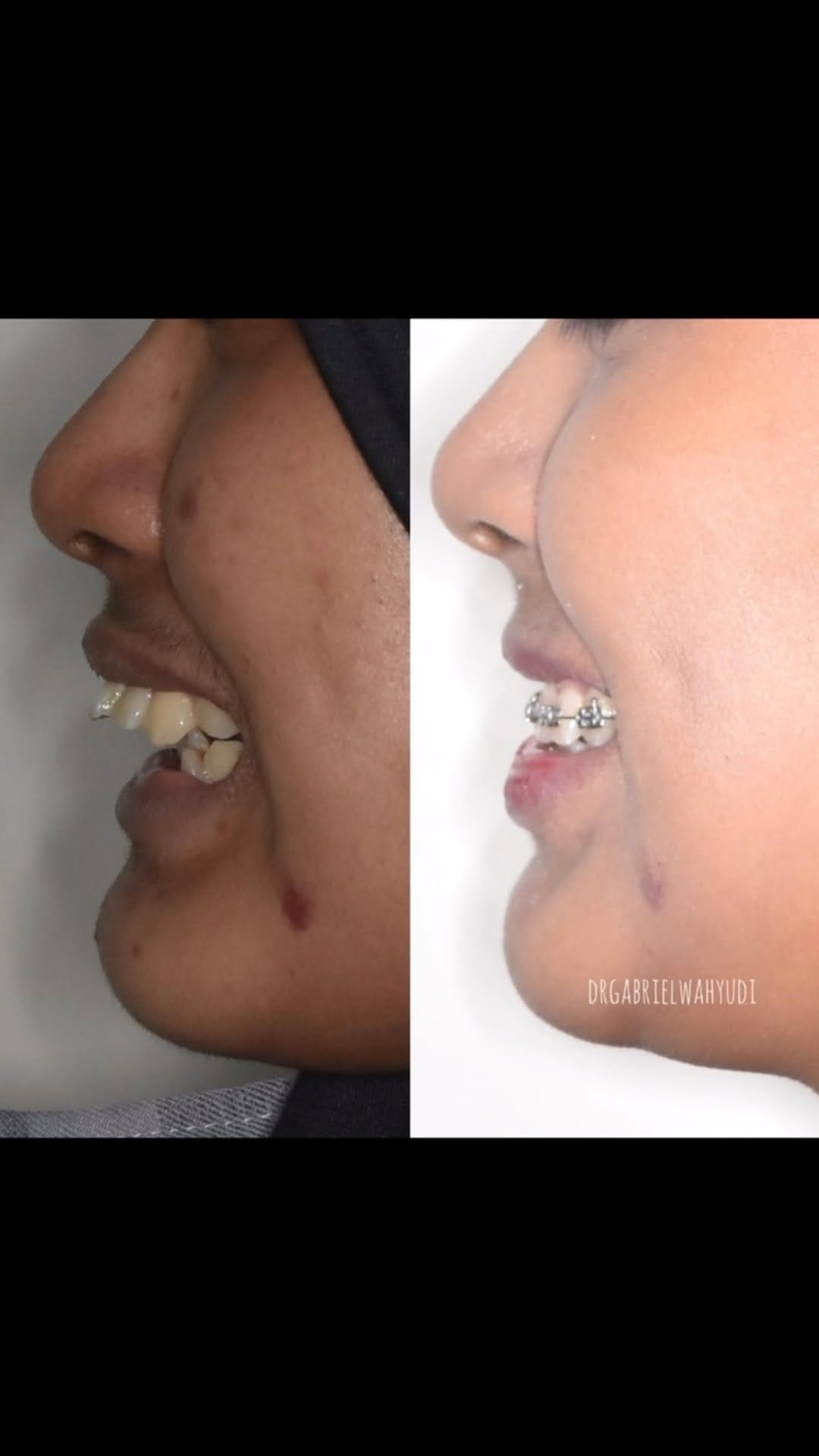 Post 9 by dr Ji Gong | DOKTER GIGI SBY on Instagram (video)