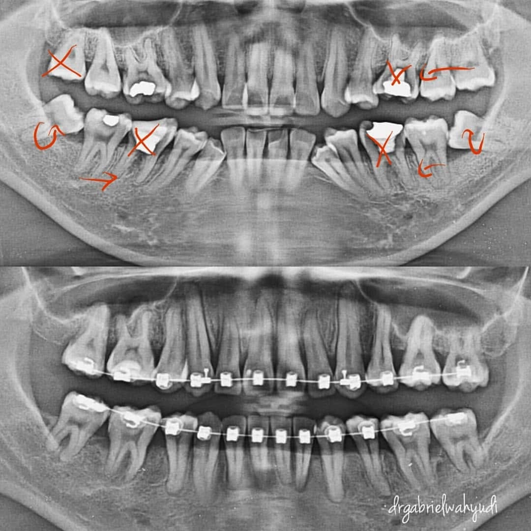 Post 10 by dr Ji Gong | DOKTER GIGI SBY on Instagram (image)