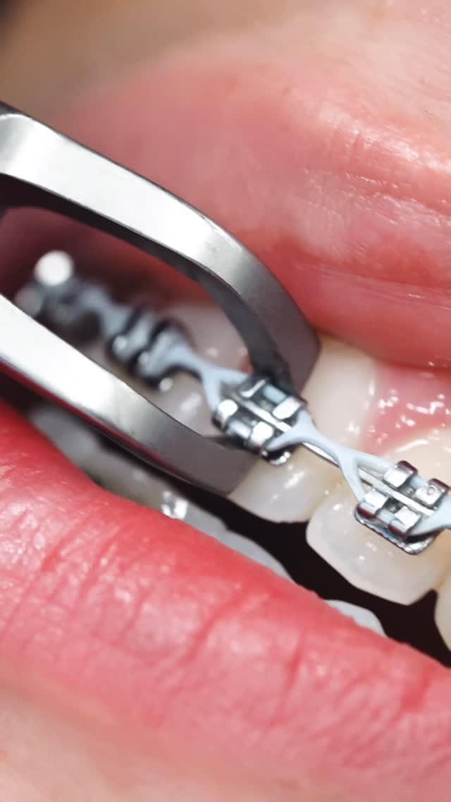 Post 8 by Elite Orthodontics on Instagram (video)