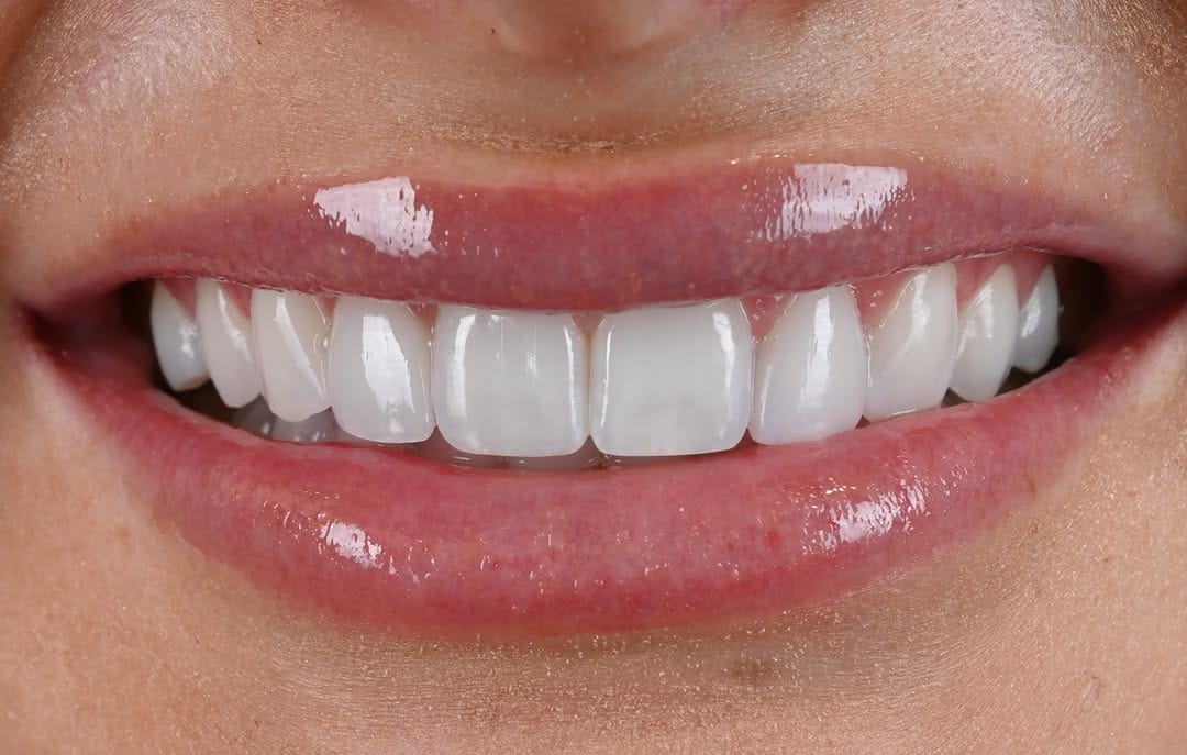 Post 6 by Dra. Anna Wilson | Seville Dental Aesthetics on Instagram (carousel)