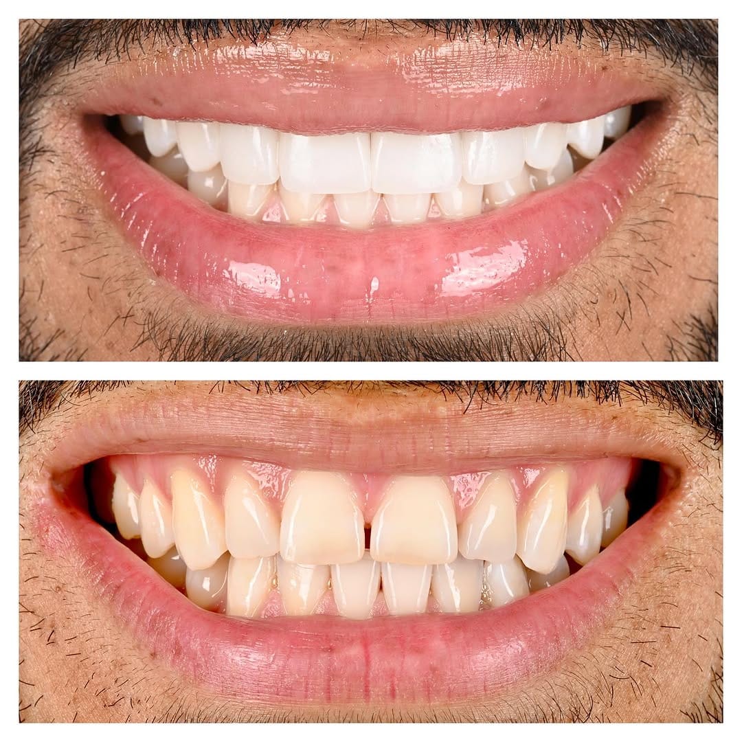 Post 9 by Dra. Anna Wilson | Seville Dental Aesthetics on Instagram (carousel)