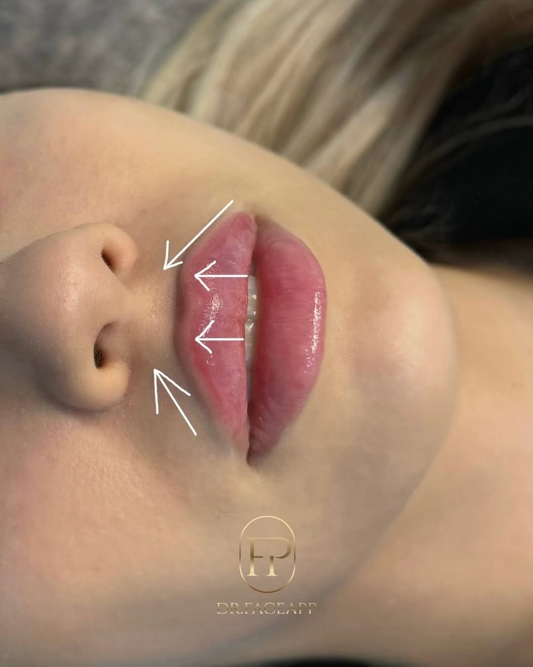 Post 1 by КОСМЕТОЛОГ РОСТОВ ЕРЕВАН COSMETOLOGIST PARIS MARSEILLE NAPLES on Instagram (image)