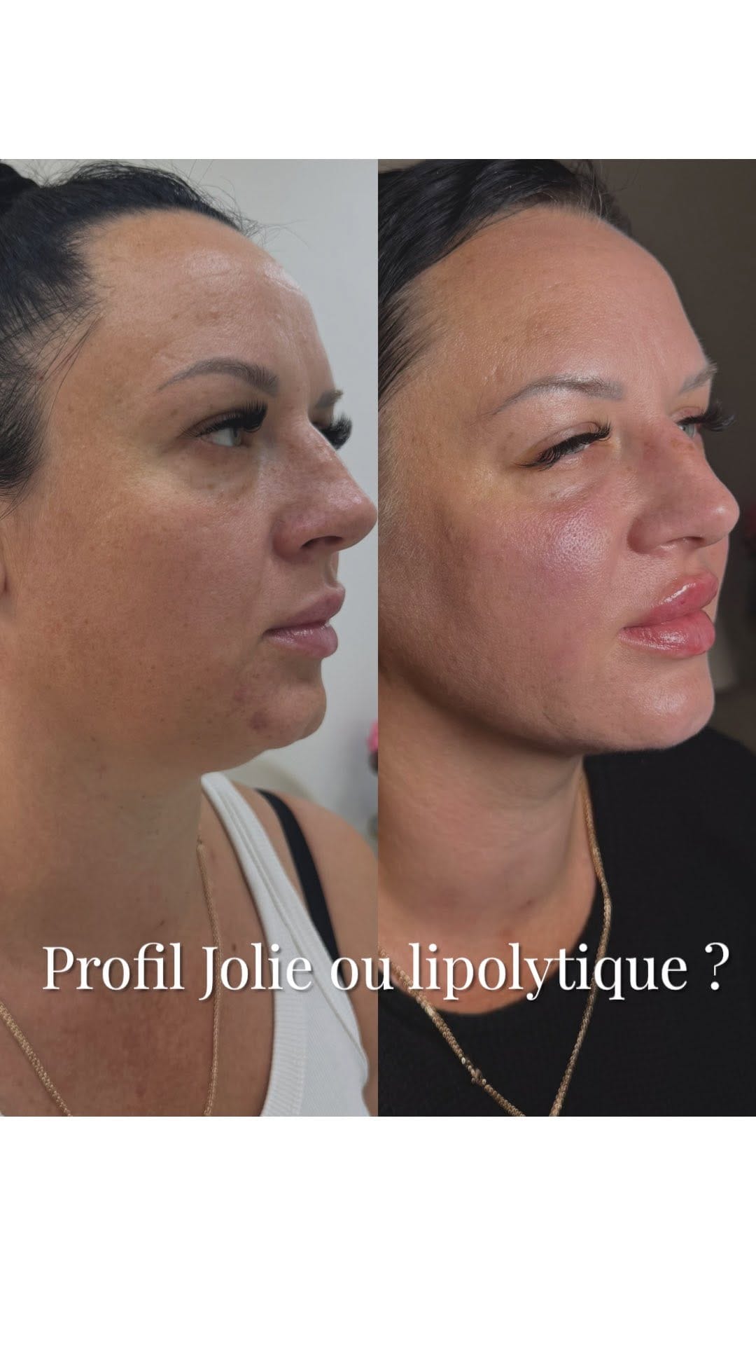 Post 6 by КОСМЕТОЛОГ РОСТОВ ЕРЕВАН COSMETOLOGIST PARIS MARSEILLE NAPLES on Instagram (video)