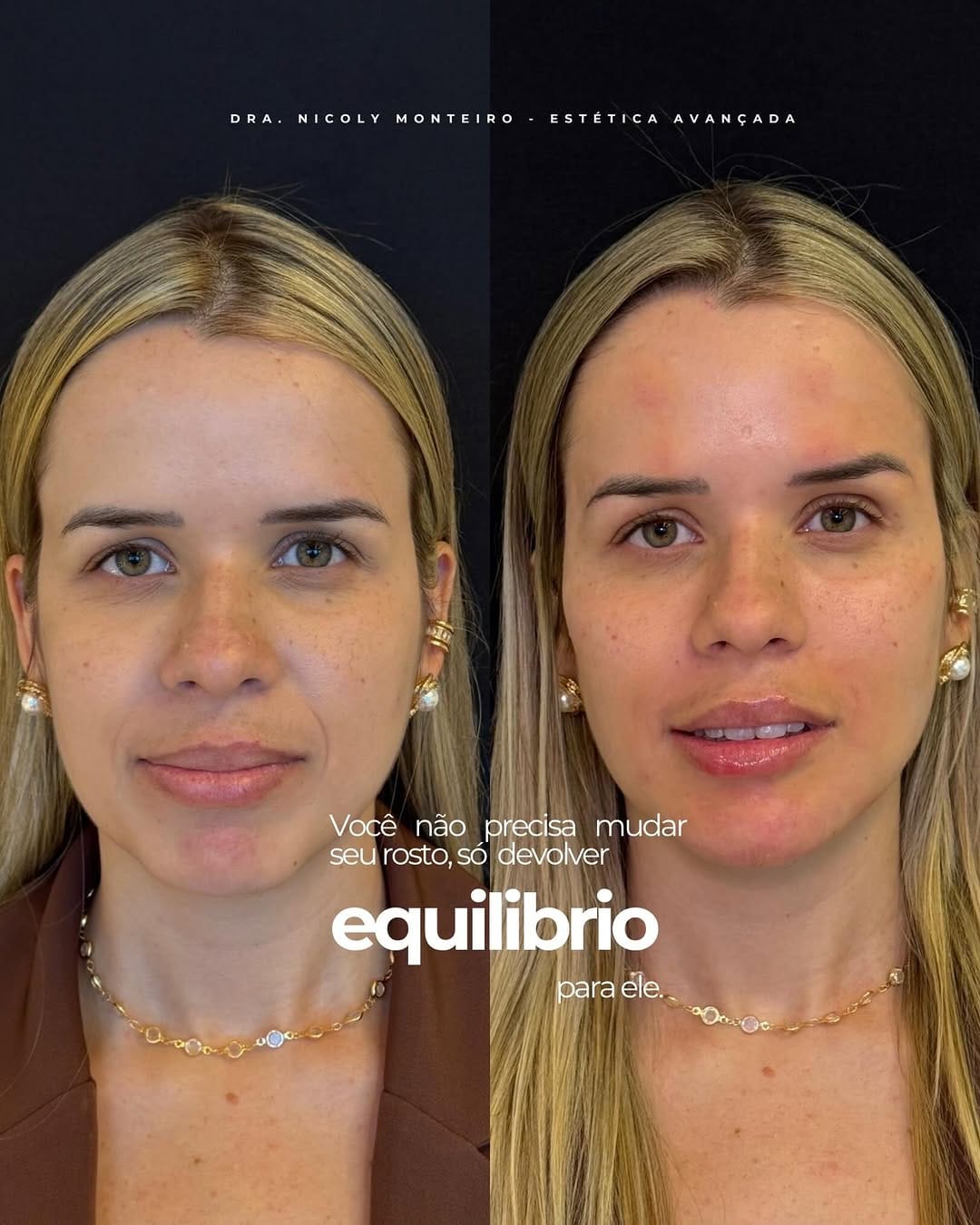 Post 4 by Nicoly Monteiro | Harmonização Facial on Instagram (carousel)