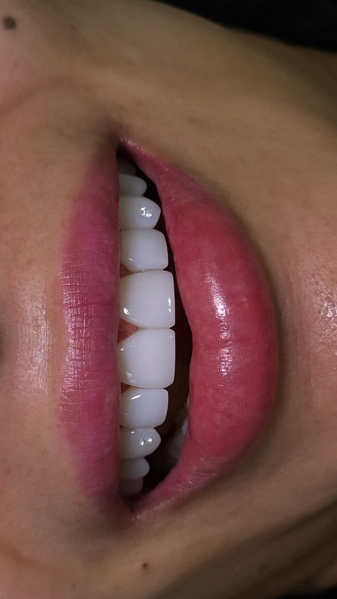 Post 8 by 𝗢𝗱𝗼𝗻𝘁𝗼𝗹𝗼𝗴𝗶𝗮 𝗵𝗶𝗴𝗵 𝗮𝗲𝘀𝘁𝗵𝗲𝘁𝗶𝗰𝘀 on Instagram (video)