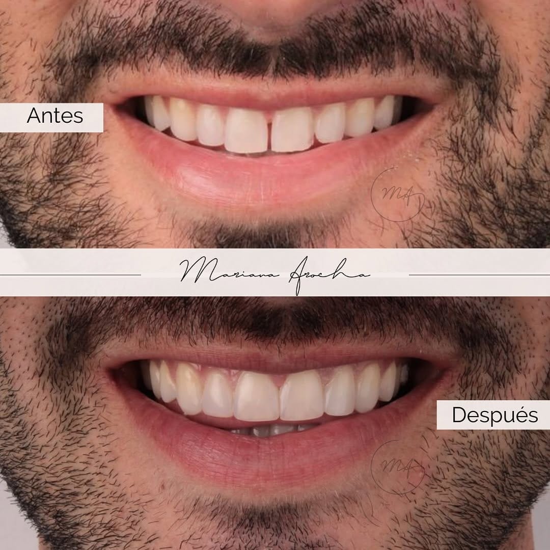 Post 10 by Mariana Arocha. MSc. PhD - Diseño de Sonrisa on Instagram (carousel)