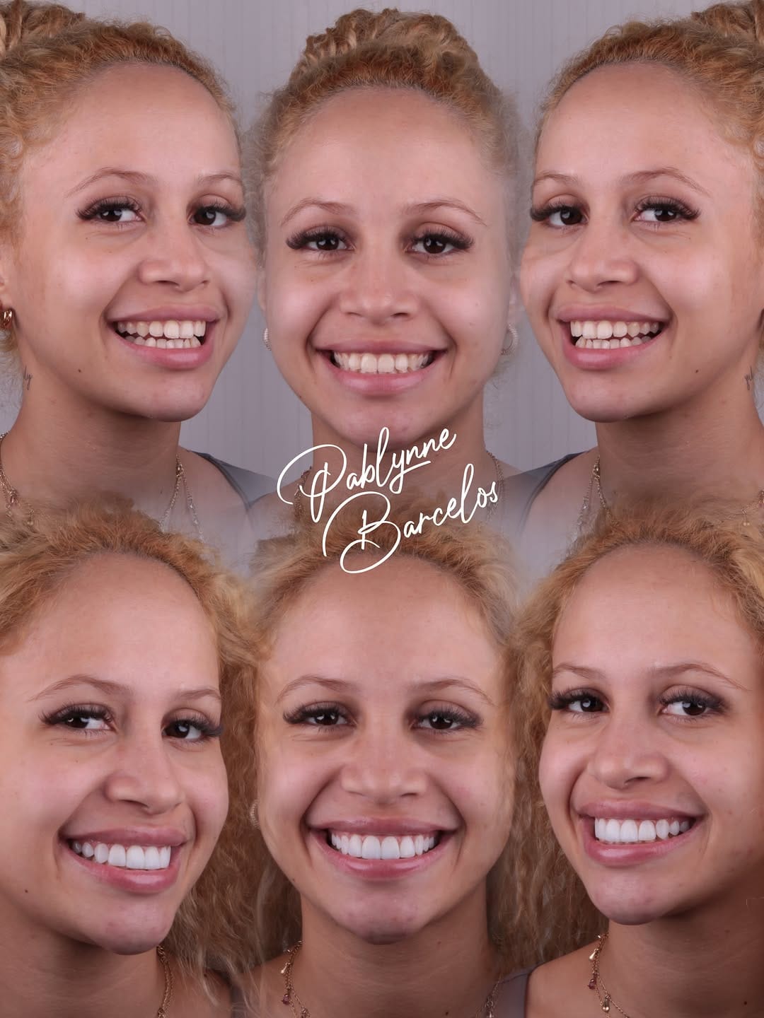 Post 8 by Dra Pablynne Barcelos | Lentes em Resina Palmas TO on Instagram (image)