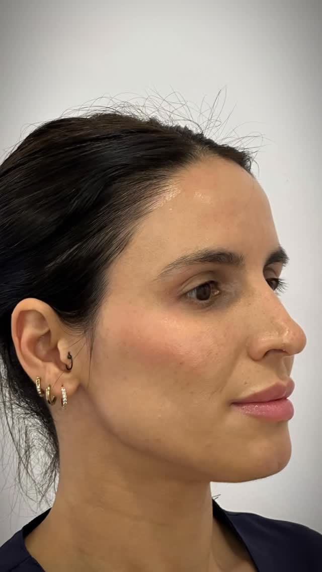 Post 10 by Medicina Estética Mallorca on Instagram (video)
