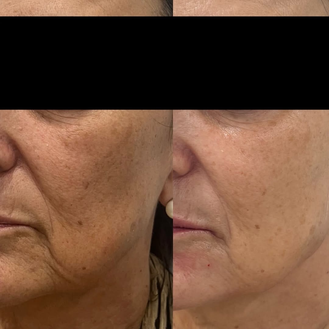Post 6 by Dra. Lucía González Ruiz - Dermatóloga - Clínica LG DERMA on Instagram (carousel)