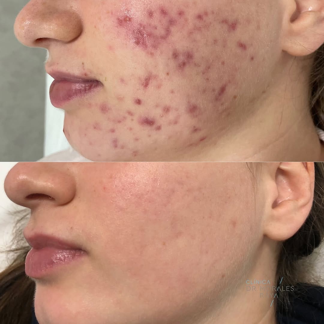Post 10 by Dra. Lucía González Ruiz - Dermatóloga - Clínica LG DERMA on Instagram (carousel)