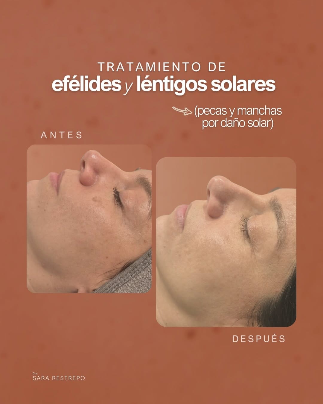 Post 2 by Dra.Camila Foronda | Botox•Ac hialurónico•Bioestimulador•Peeling on Instagram (carousel)