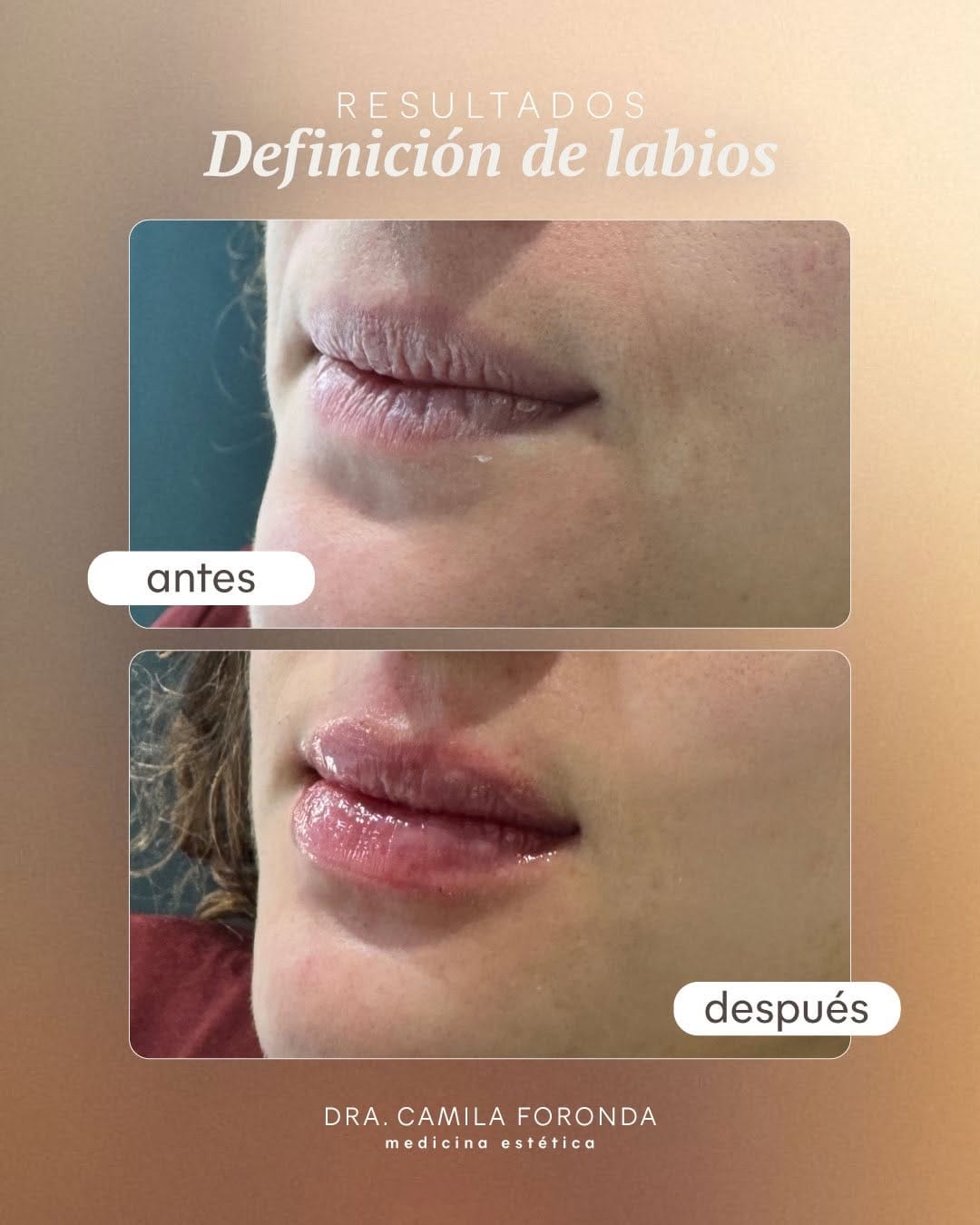 Post 7 by Dra.Camila Foronda | Botox•Ac hialurónico•Bioestimulador•Peeling on Instagram (carousel)