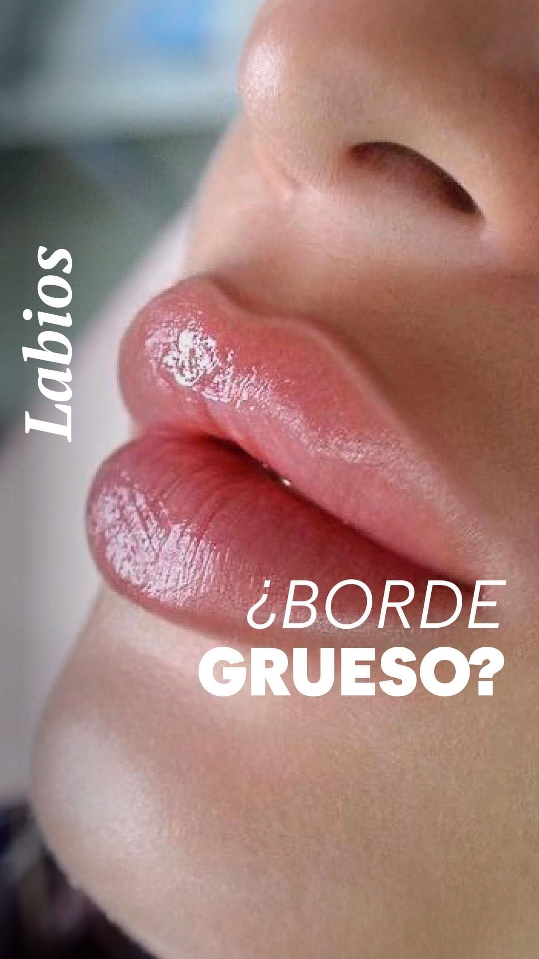 Post 9 by Dra.Camila Foronda | Botox•Ac hialurónico•Bioestimulador•Peeling on Instagram (video)