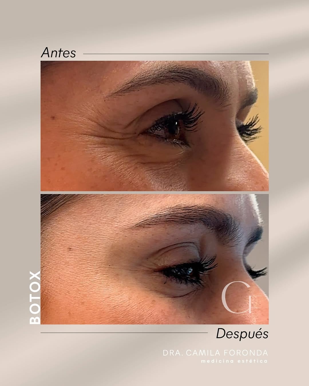 Post 10 by Dra.Camila Foronda | Botox•Ac hialurónico•Bioestimulador•Peeling on Instagram (carousel)