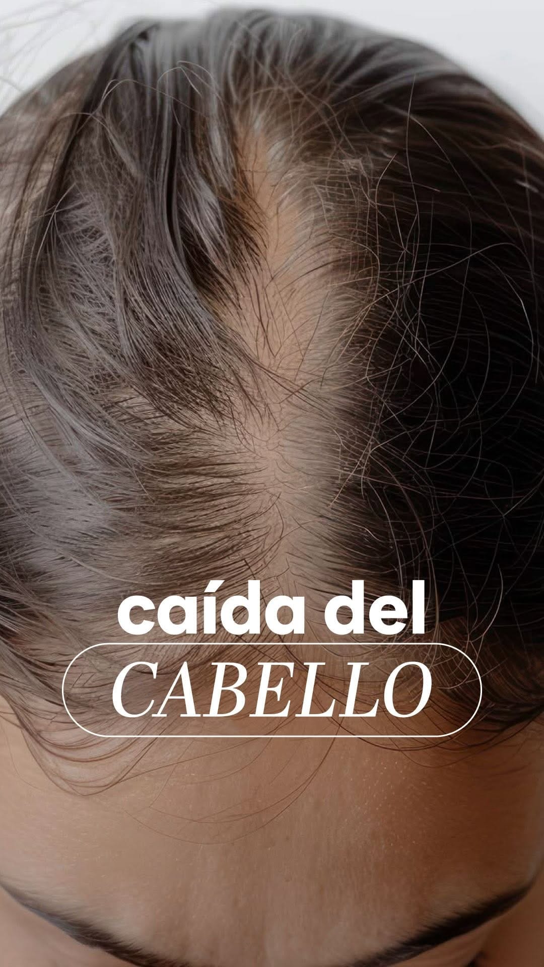 Post 3 by Dra.Camila Foronda | Botox•Ac hialurónico•Bioestimulador•Peeling on Instagram (video)