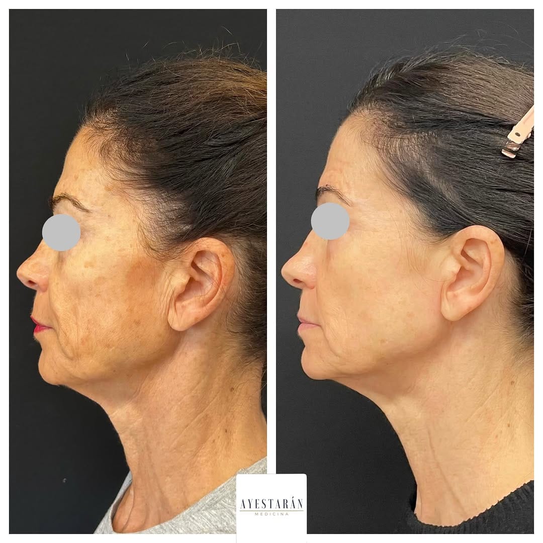 Post 6 by Ayestarán Medicina |Medicina Estética |Regenerativa |Longevidad on Instagram (image)