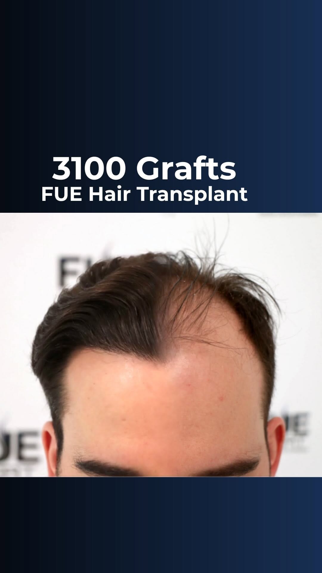 Post 8 by FUExpert Clinic on Instagram (video)