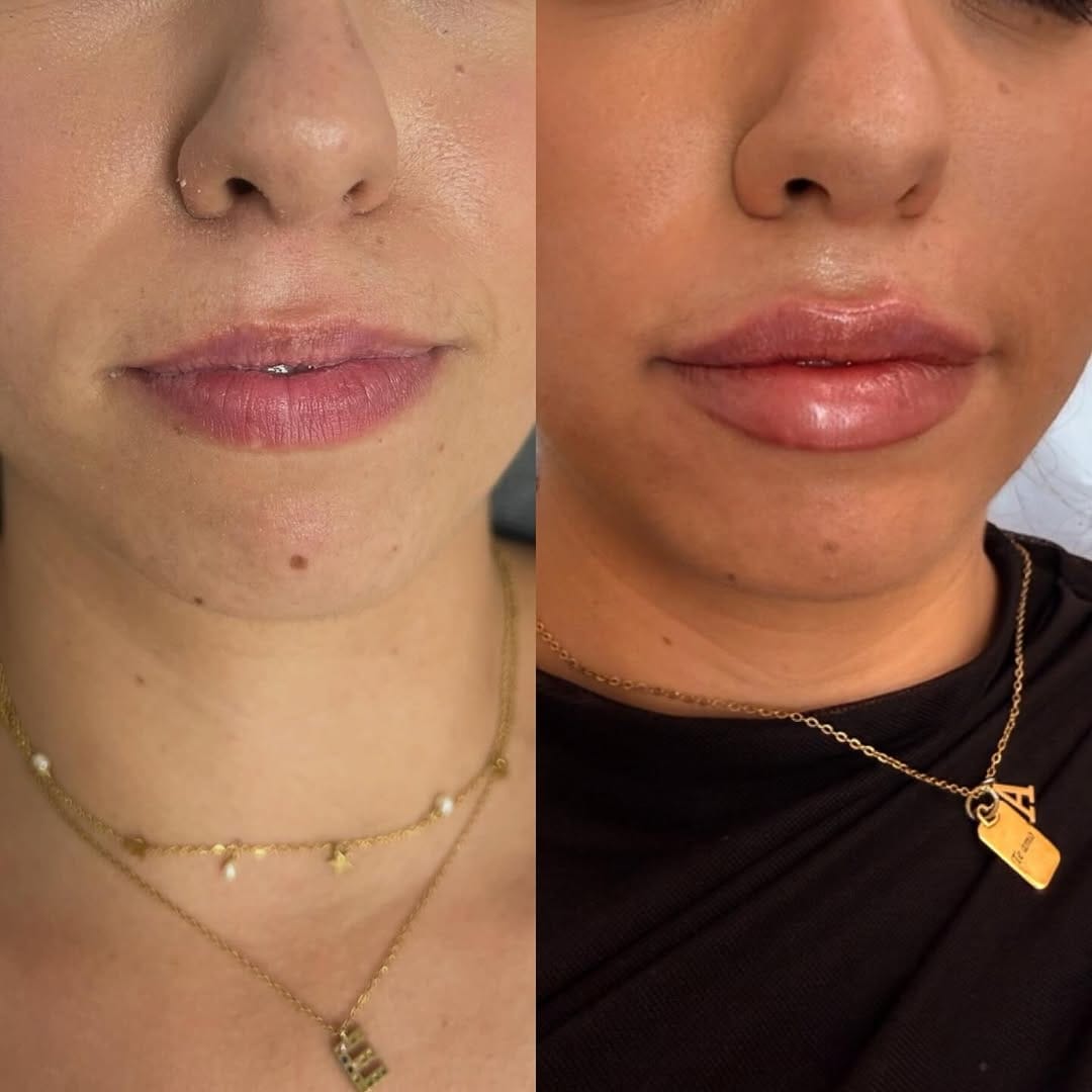 Post 5 by Leire Hernández | Medicina Estética on Instagram (carousel)