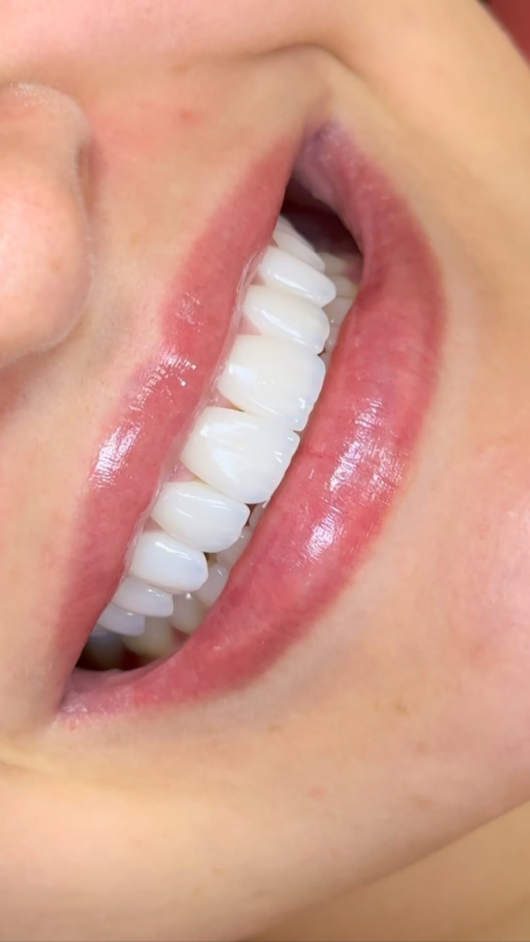 Post 9 by Dr. Thalliton | Facetas & Lentes on Instagram (video)