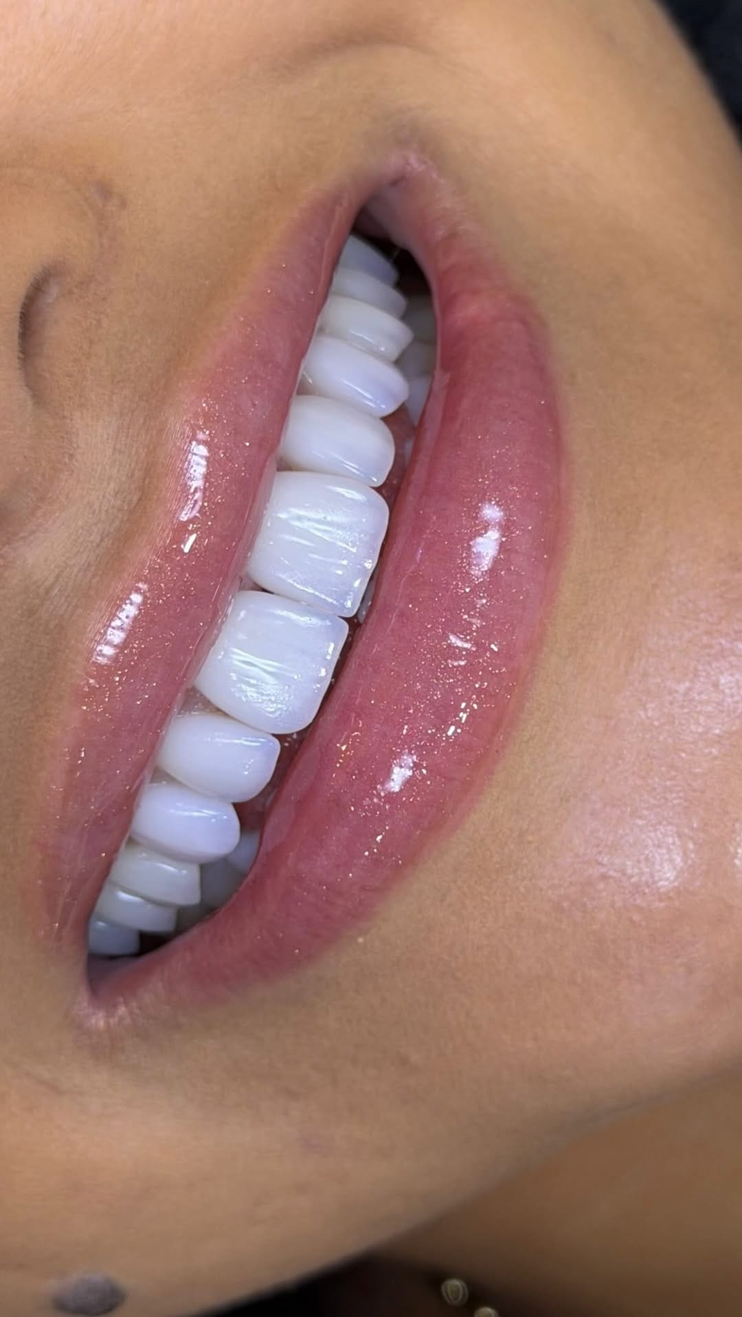 Post 2 by Dr. Thalliton | Facetas & Lentes on Instagram (video)