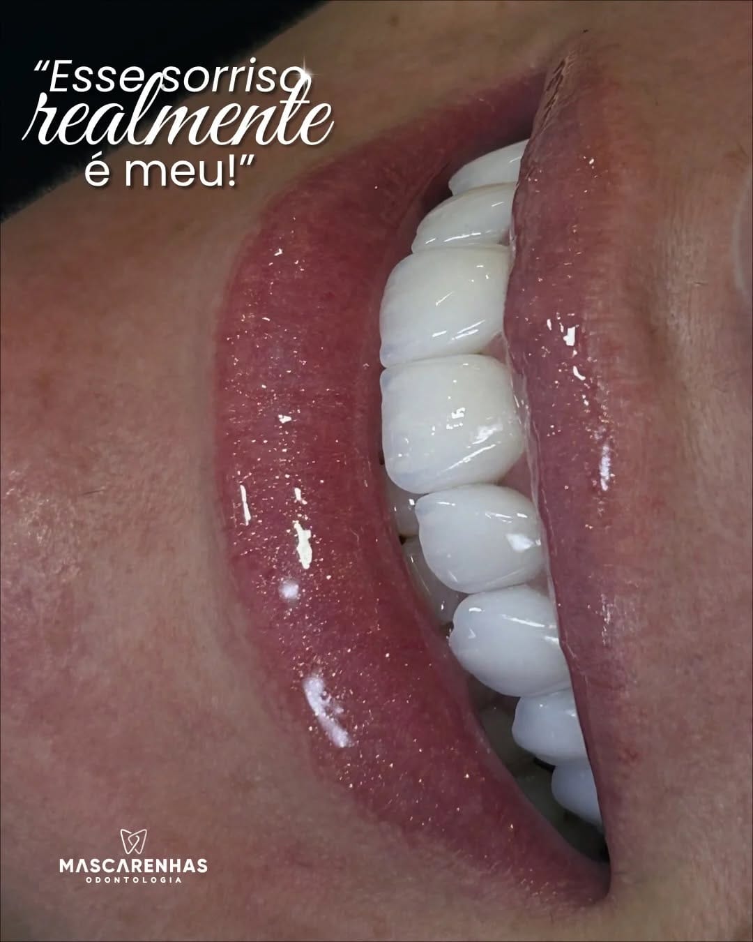 Post 5 by Dr. Thalliton | Facetas & Lentes on Instagram (carousel)