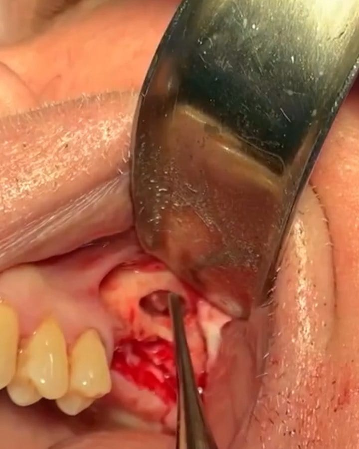 Post 6 by Dr. Baptiste Chailan on Instagram (video)