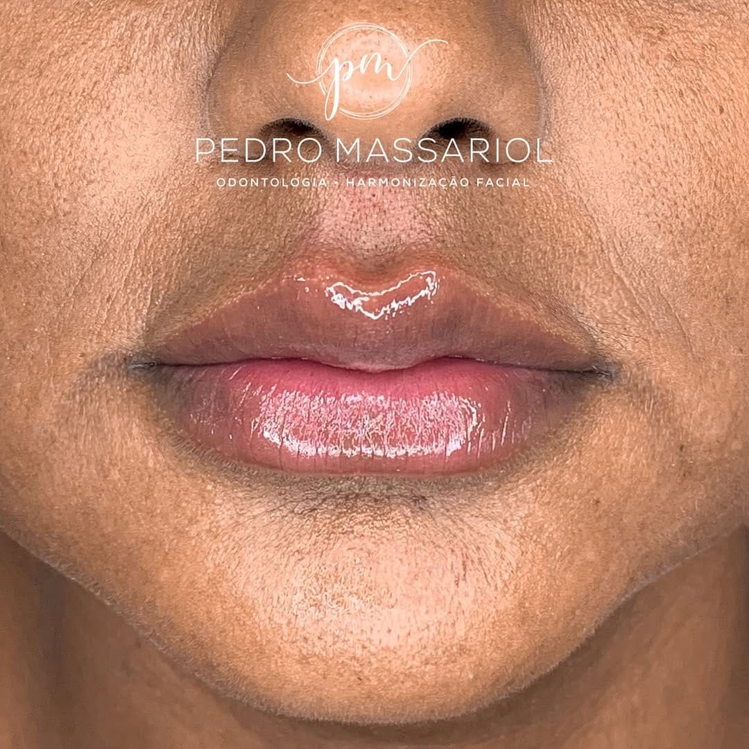 Post 10 by Pedro Massariol | Harmonização Facial on Instagram (carousel)