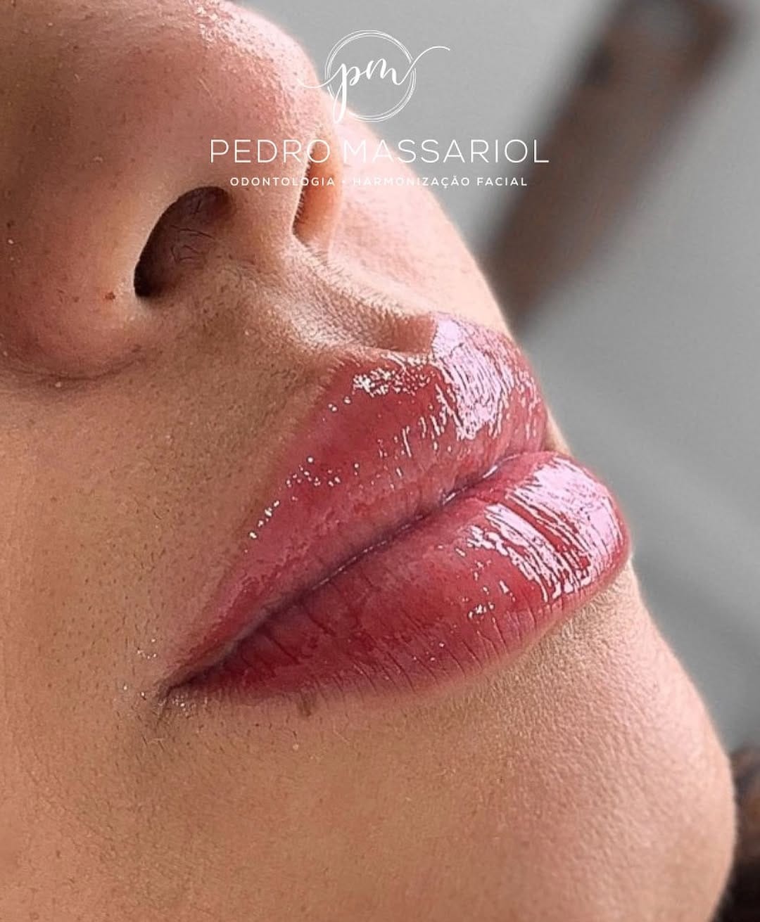 Post 9 by Pedro Massariol | Harmonização Facial on Instagram (carousel)