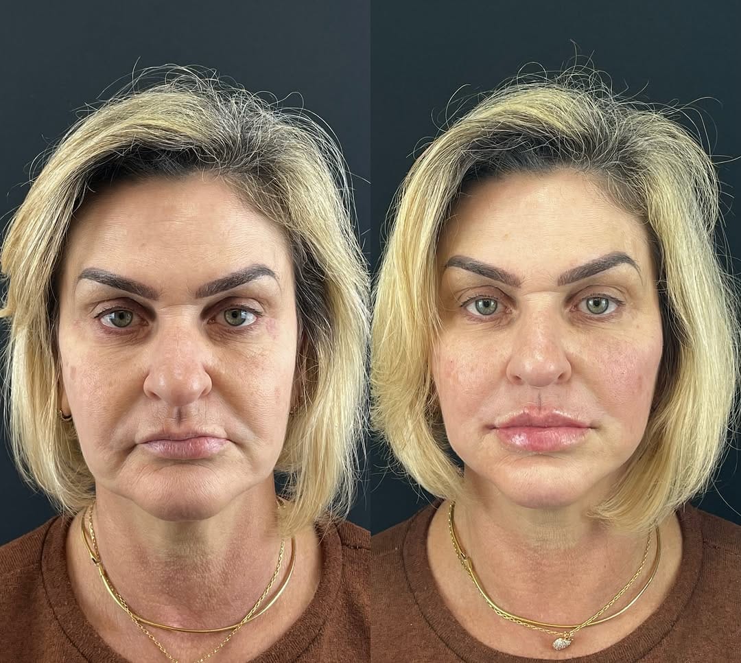 Post 5 by Pedro Massariol | Harmonização Facial on Instagram (carousel)
