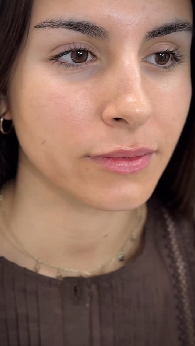 Post 7 by Dr. Katerina Sanchez | Medicina estética • Valencia,Alicante on Instagram (video)