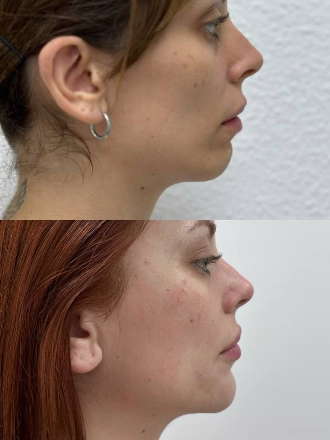 Post 3 by Dr. Katerina Sanchez | Medicina estética • Valencia,Alicante on Instagram (carousel)