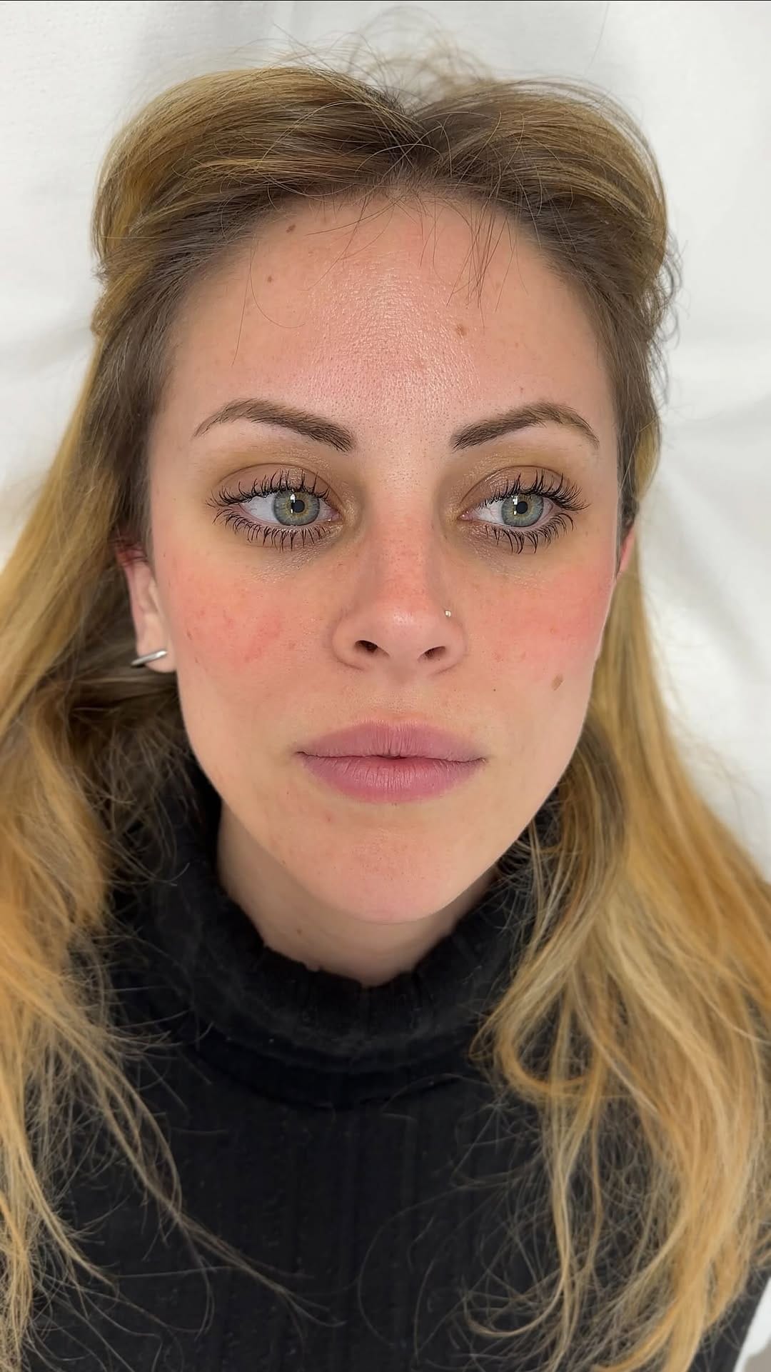 Post 9 by Dr. Katerina Sanchez | Medicina estética • Valencia,Alicante on Instagram (video)