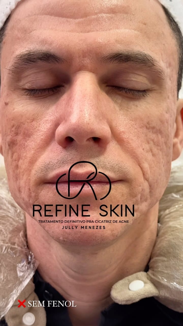 Post 9 by Jully Menezes - Cicatriz de Acne on Instagram (video)