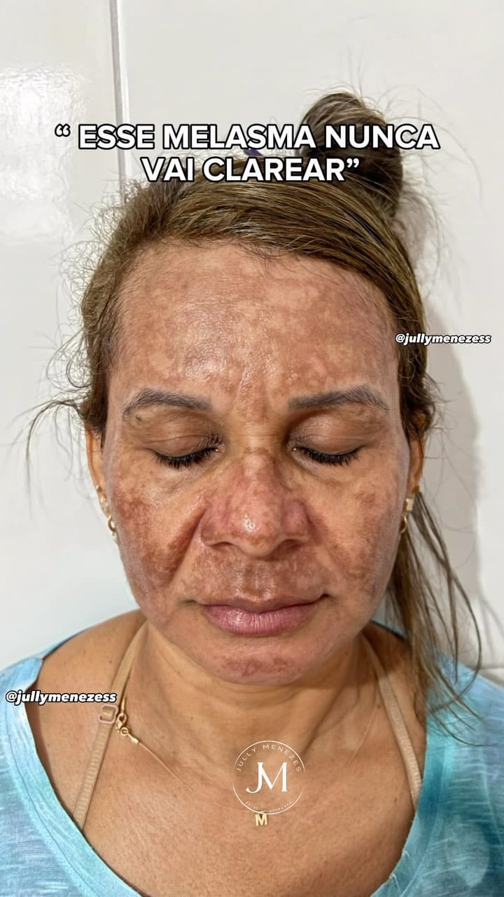 Post 10 by Jully Menezes - Cicatriz de Acne on Instagram (video)