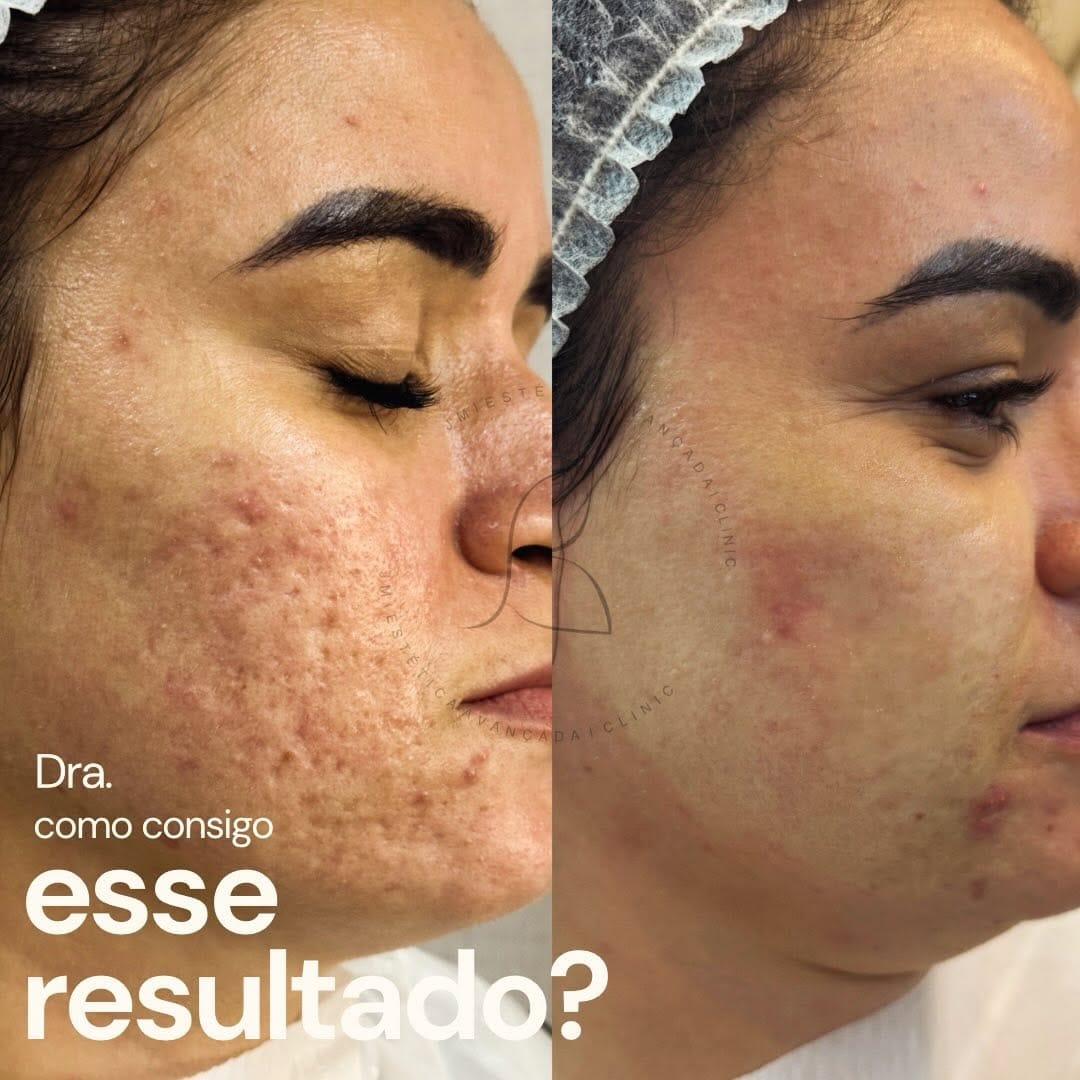 Post 7 by Jully Menezes - Cicatriz de Acne on Instagram (carousel)