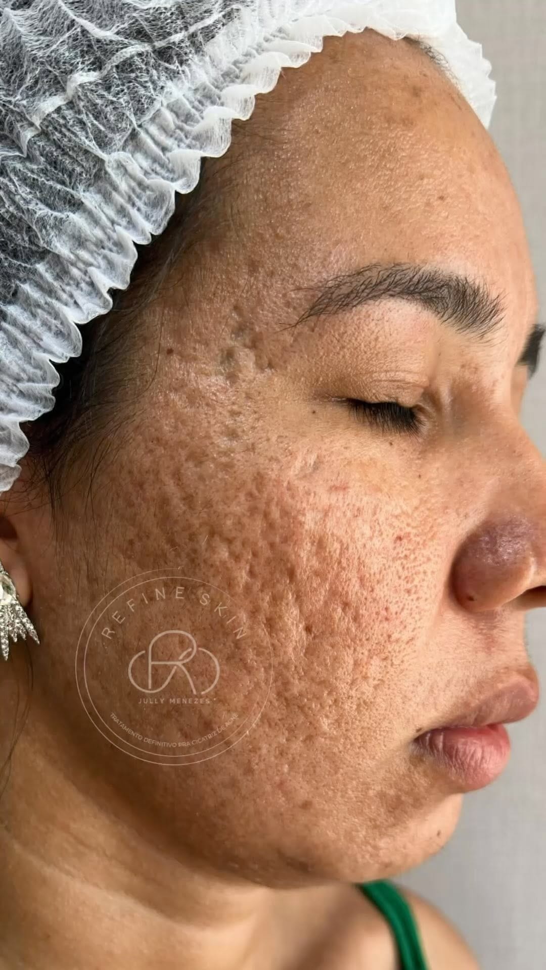 Post 8 by Jully Menezes - Cicatriz de Acne on Instagram (video)