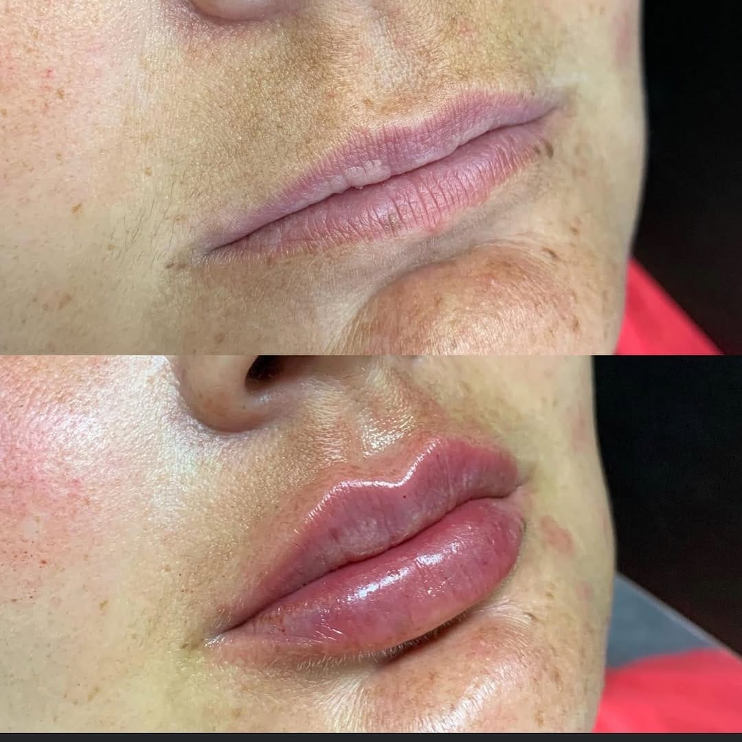 Post 10 by Alessandra Jereissati|Harmonização Facial on Instagram (image)