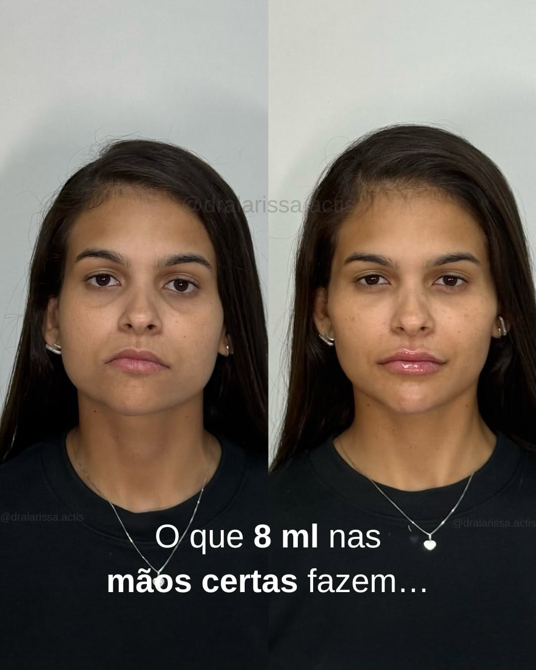 Post 6 by Larissa Actis - Harmonização Facial on Instagram (carousel)