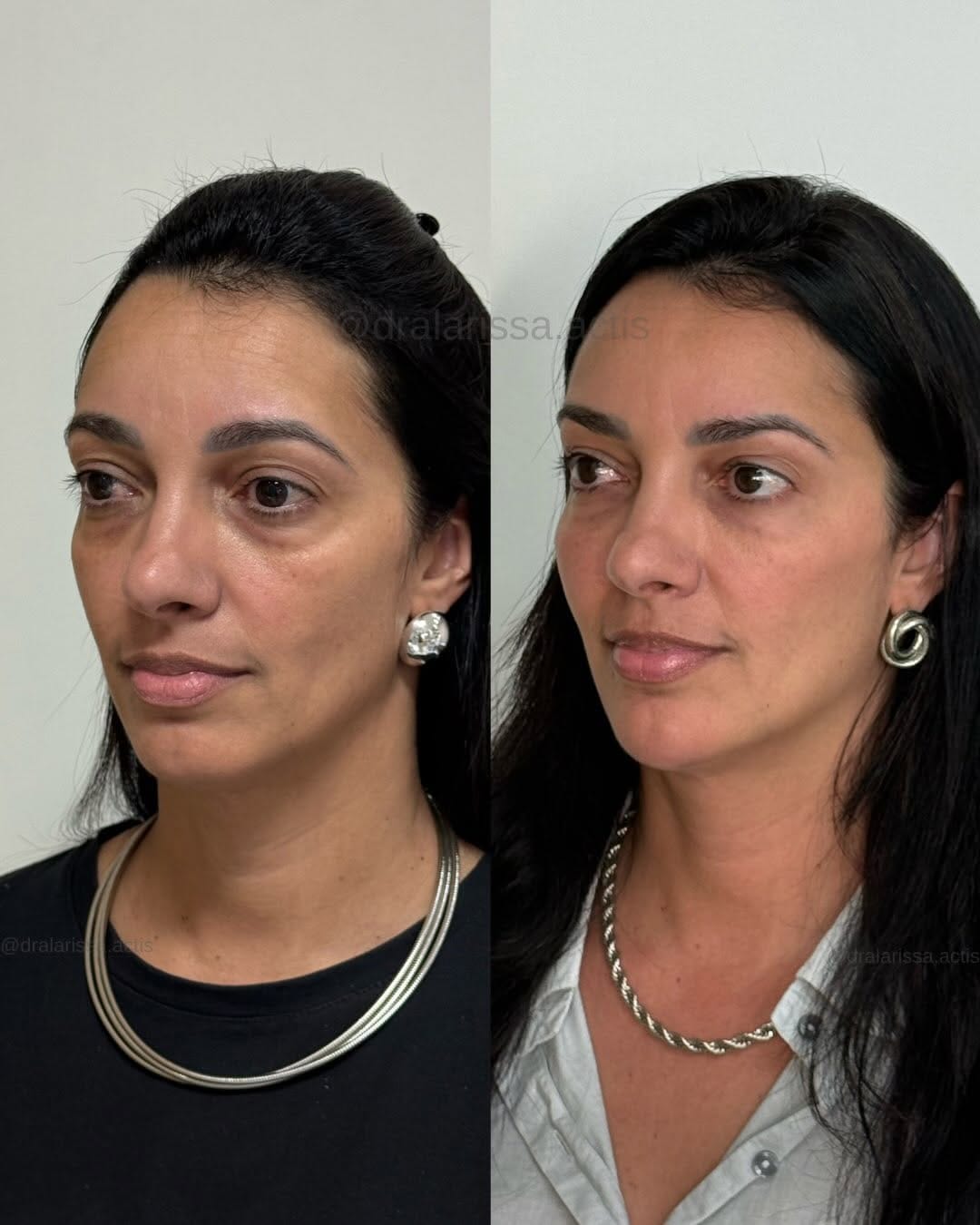 Post 2 by Larissa Actis - Harmonização Facial on Instagram (carousel)