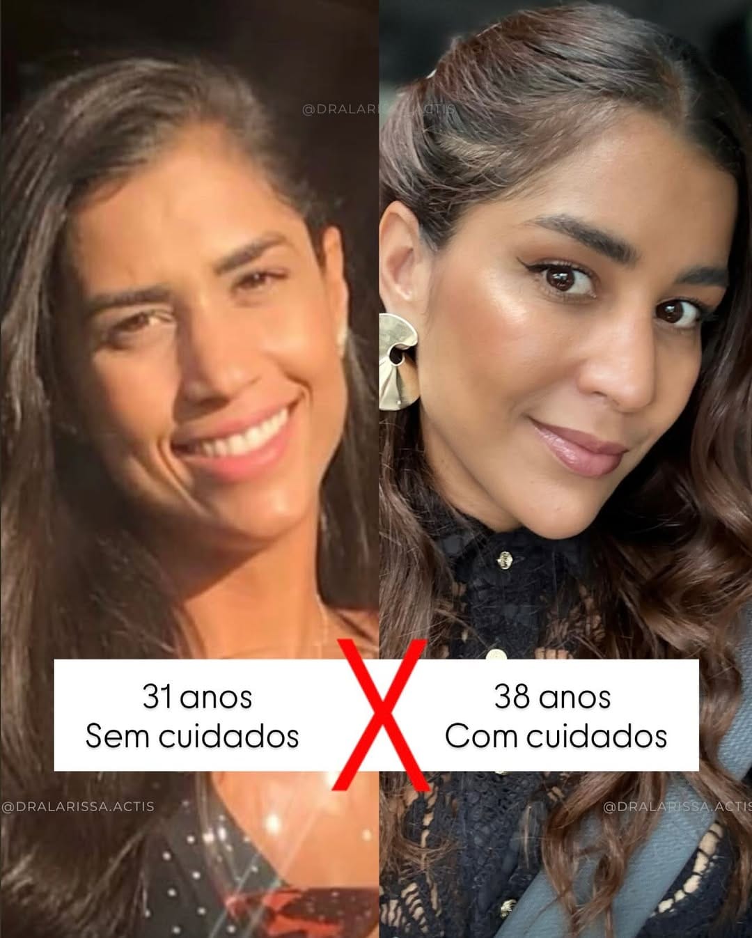 Post 10 by Larissa Actis - Harmonização Facial on Instagram (carousel)