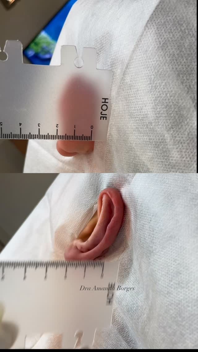 Post 3 by Dra Amanda Borges | OTOMODELAÇÃO🪡👂🏼 on Instagram (video)