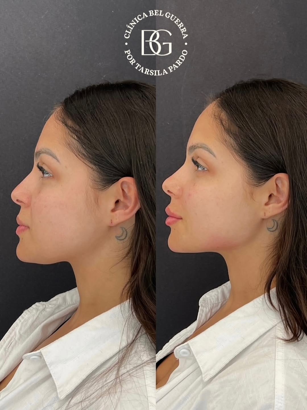 Post 10 by Dra. Tarsila Pardo | Harmonização Facial Campinas on Instagram (carousel)