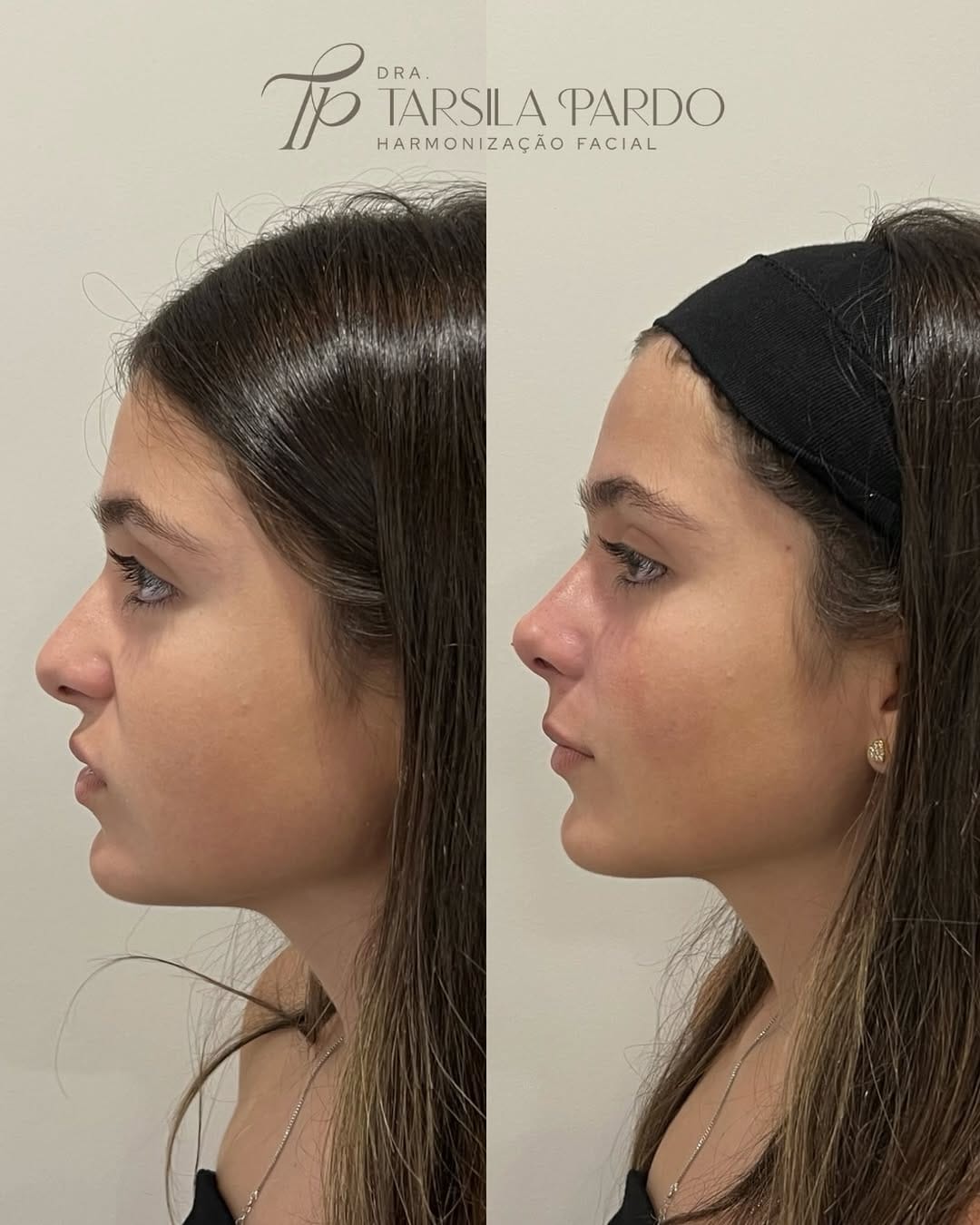 Post 4 by Dra. Tarsila Pardo | Harmonização Facial Campinas on Instagram (image)