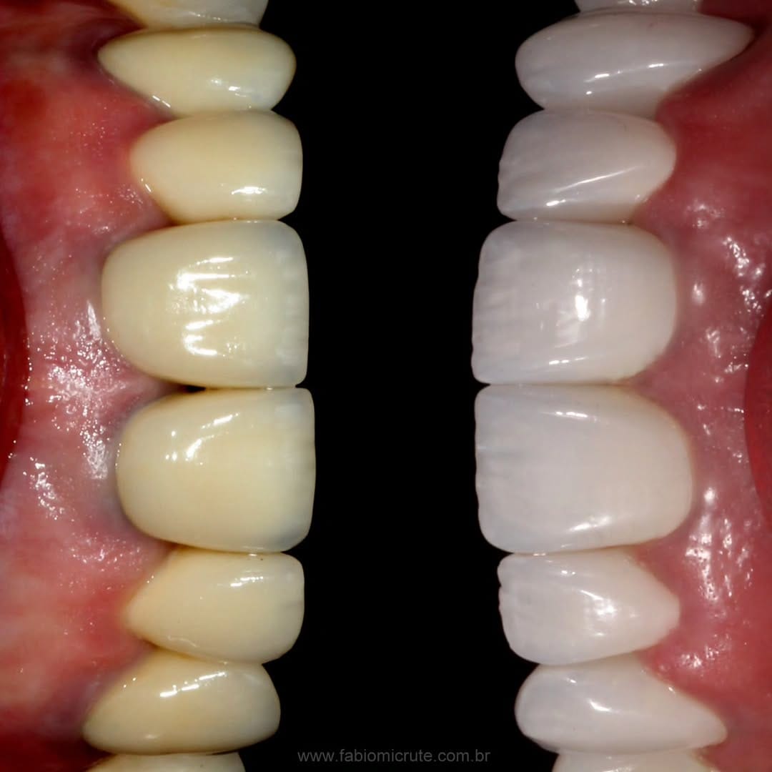 Post 7 by Fabio Micrute Odontologia 🇧🇷 on Instagram (image)