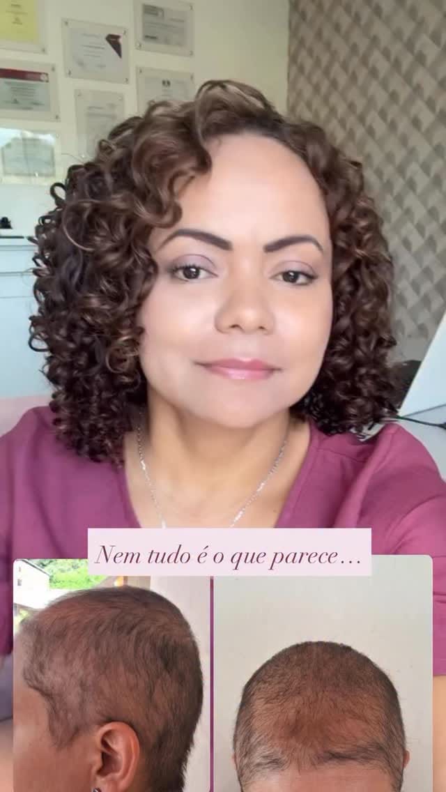 Post 8 by Clínica Recupere Tricologia on Instagram (video)