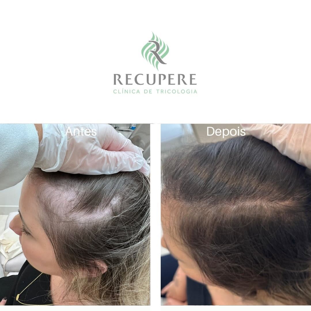 Post 2 by Clínica Recupere Tricologia on Instagram (image)