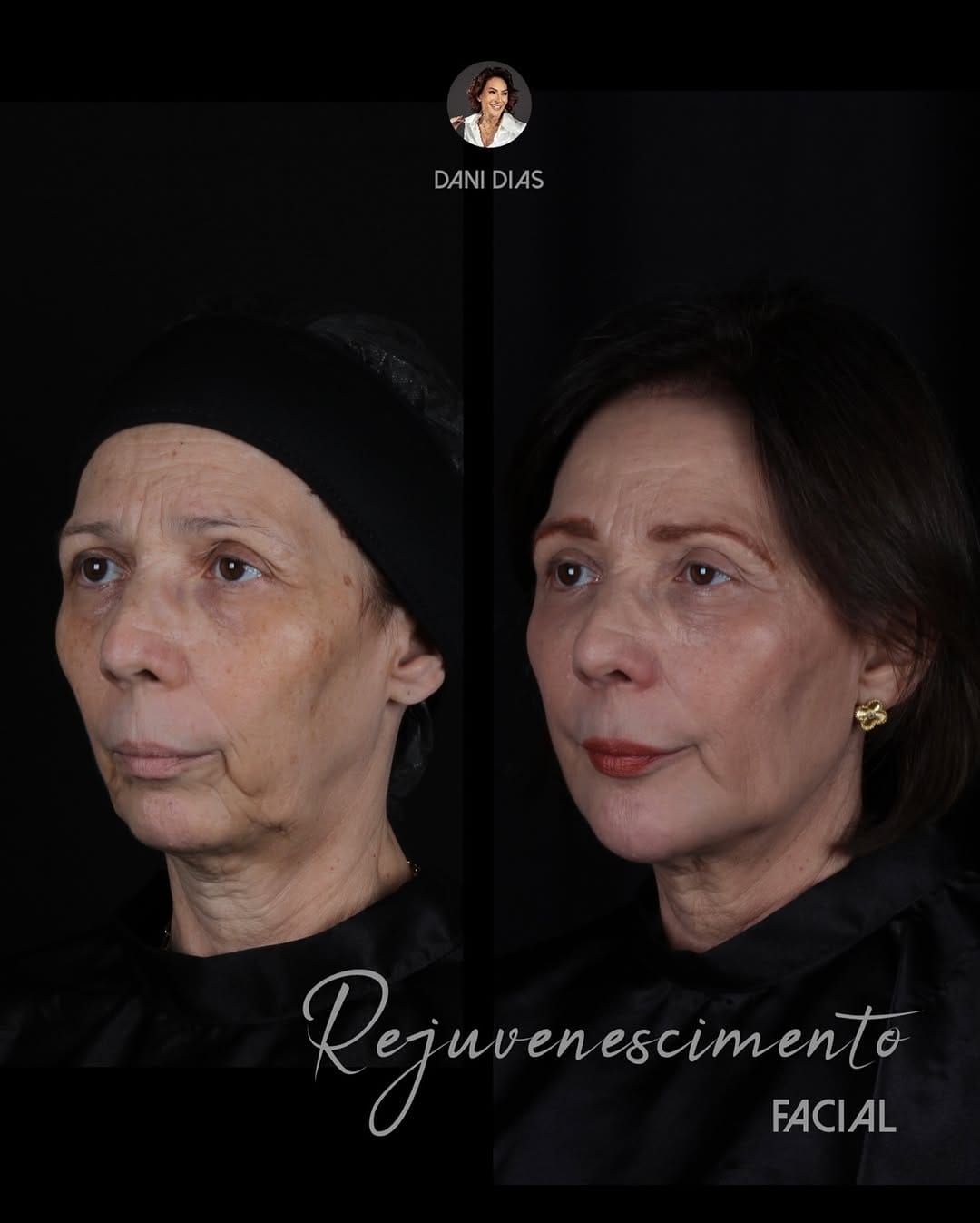 Post 8 by Danielle Dias • Harmonização Facial on Instagram (carousel)
