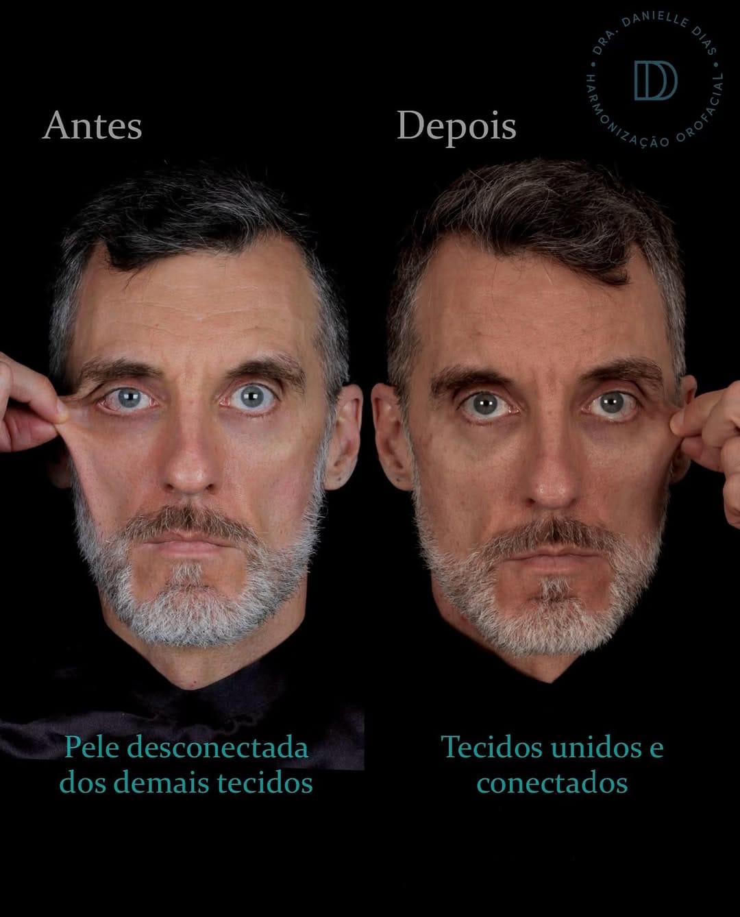 Post 10 by Danielle Dias • Harmonização Facial on Instagram (carousel)